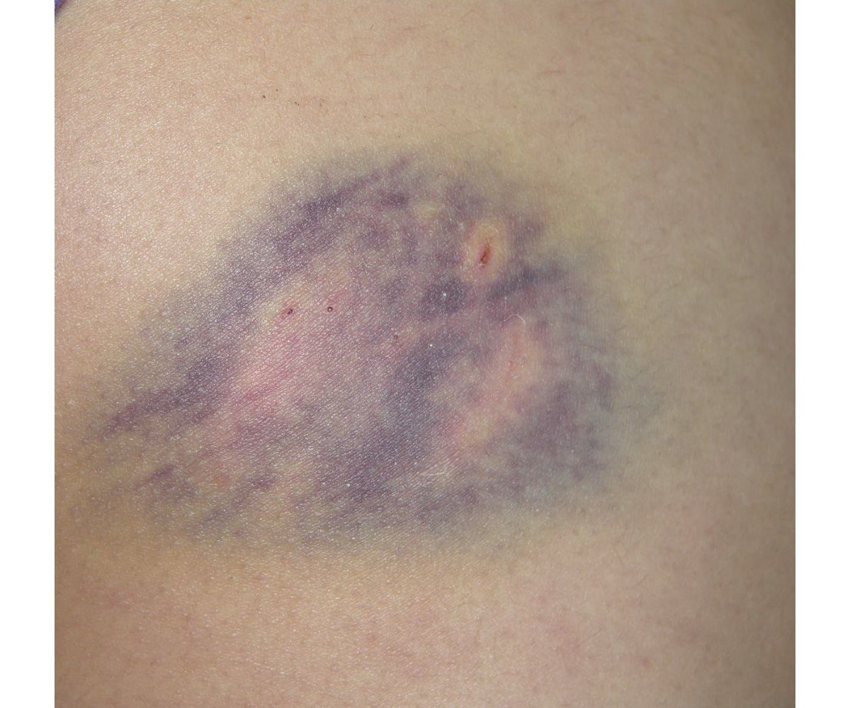 dog bite buttocks dog bite buttocks
